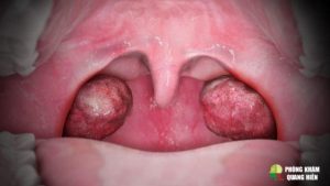 cách chữa viêm amidan, cách trị dứt điểm viêm amidan