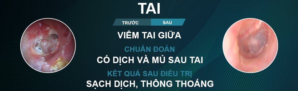nội soi tai có đau không
