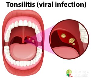 viêm amidan hốc mủ