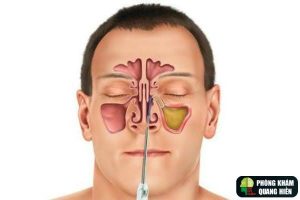 hút dịch xoang mũi ở đâu