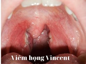 viêm họng vincent