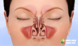 Nội soi xoang mũi