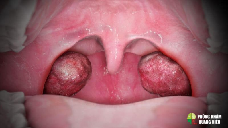 Cách chữa viêm amidan tại nhà cho trẻ