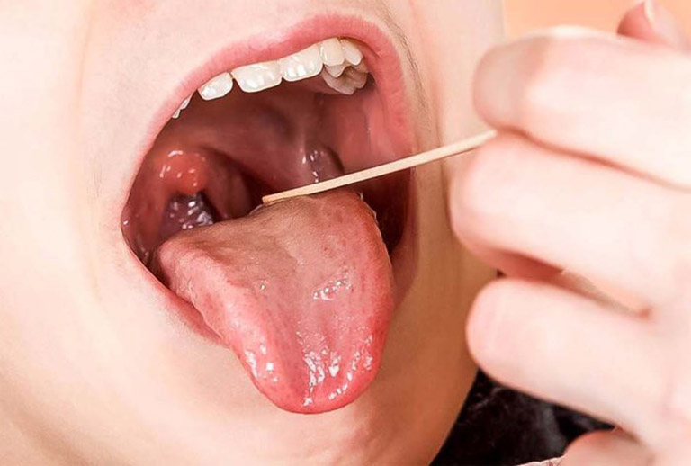 viêm amidan cấp mủ ở trẻ em