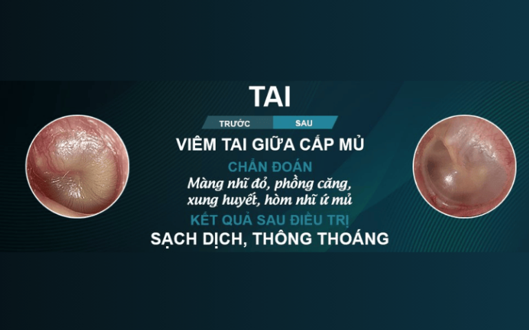 7 Dấu Hiệu Viêm Tai Giữa Ở Bé Thường Gặp Và Cách Xử Lý