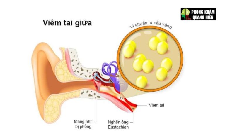5+ Cách điều trị viêm tai giữa mãn tính, hết lo biến chứng
