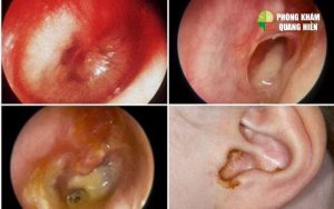 lý do bị viêm tai giữa